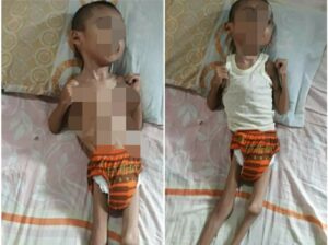 Ahmadul, Bocah Penderita Penyakit Aneh di Bireuen Sudah 6 Tahun Terbaring Butuh Uluran Tangan