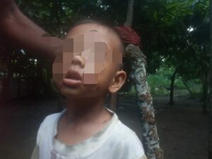 Tega, Bocah Bisu di Aceh Utara Dianiaya Ayah Kandung, Dibakar dengan Bara Api